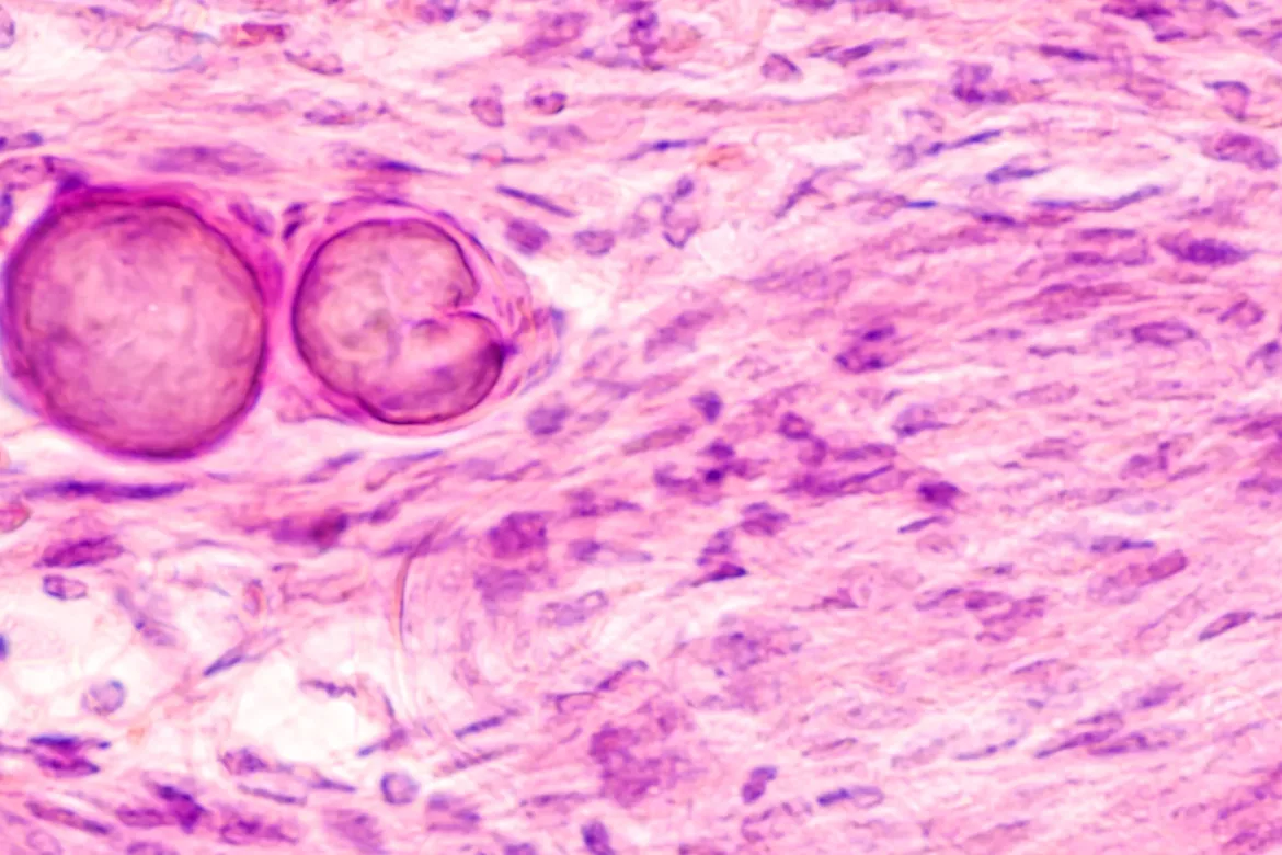 #nivoslider-caption-200 Często spotykane pierwotne guzy mózgu to oponiaki (łac. meningioma).