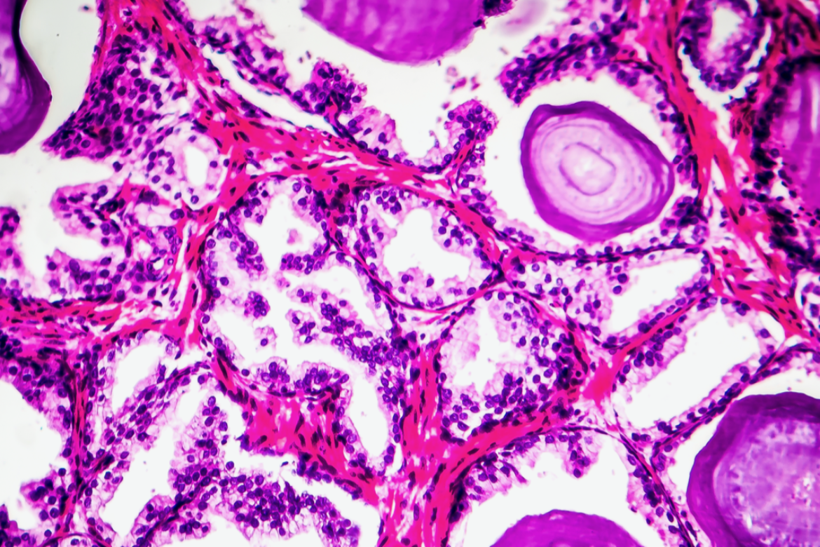 #nivoslider-caption-357 Histopatologia przerostu gruczołu krokowego. Histopathology of prostate gland hyperplasia.