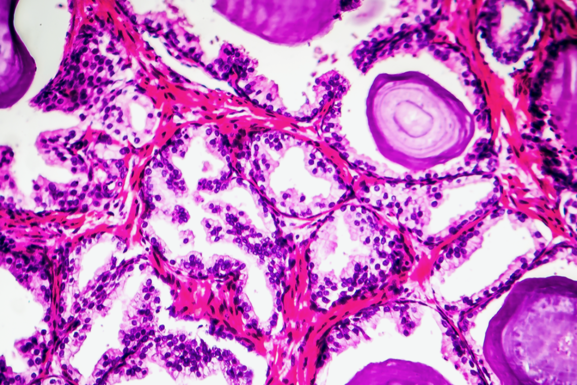 Histopatologia przerostu gruczołu krokowego. Histopathology of prostate gland hyperplasia.